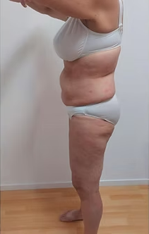 Nachher – Bauch & Taille