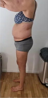 Nachher – Bauch & Taille – Seitenprofil